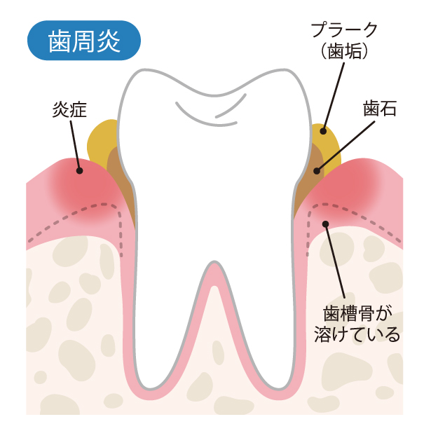 歯周病の構造